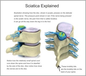 Sciatic pain explained