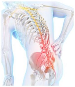 Slipped disc, sciatica, nerve pain