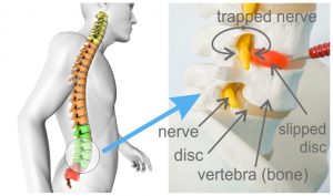 Image showing how nerve is trapped