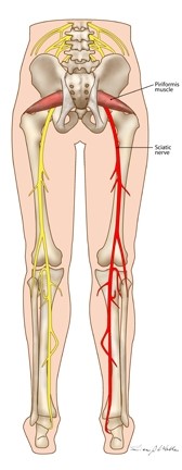 sciatic pain can extend right down the leg