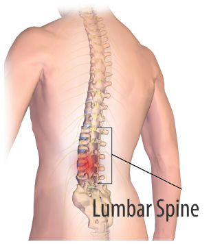 Treatment for low back pain Low back pain