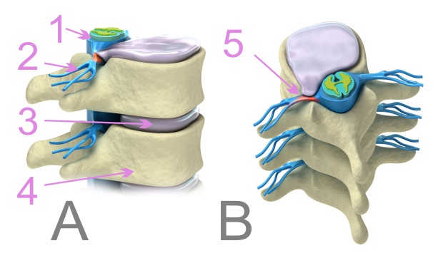 Slipped disc treatment