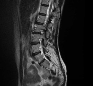 back pain MRI shows nothing