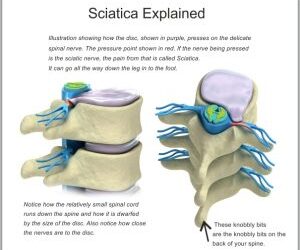What is Sciatica, Its Causes, Symptoms and How to Get Relief